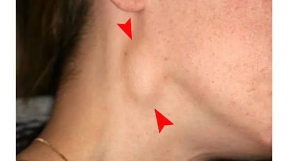 Neck swelling